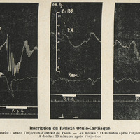 Inscription du Reflexe Oculo-Cardiaque. A gauche : avant l'injection d'extrait de Viola. — Au…