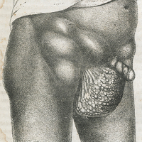 Fig. 5. — Lympho-scrotum (d'après V. Carter).