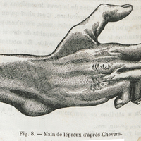 Fig. 8. — Main de lépreux d'après Chevers.