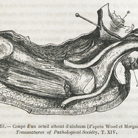 Fig. 13. — Coupe d'un orteil attent d'aïnhum (d'après Wood et Morgan). Transactures of Pathological…